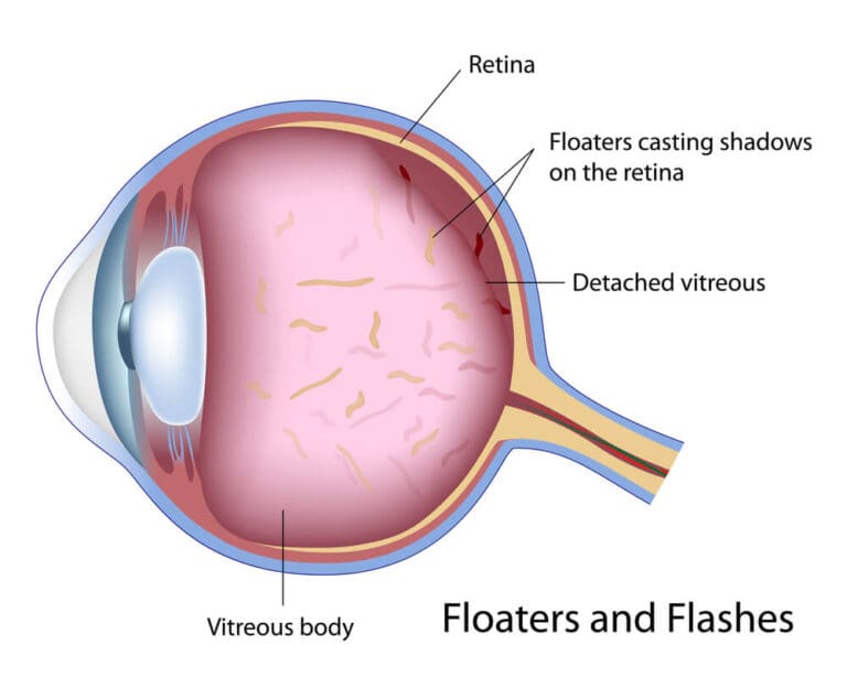 Guilda Floaters Best Floaters Treatment & Eye Flashes Treatment in Florida
